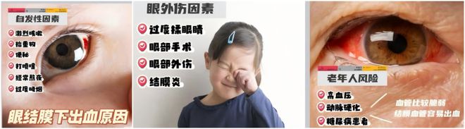 发现眼球出血？医生：不必惊慌！龙8游戏网址健康科普丨睡醒后(图4)